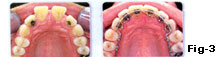 dental implant surgery