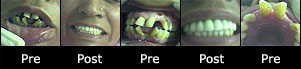 root canal treatment crowns