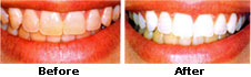 natural teeth whitening in delhi