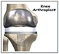 Knee Arthroplast